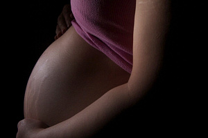 Растяжки на теле